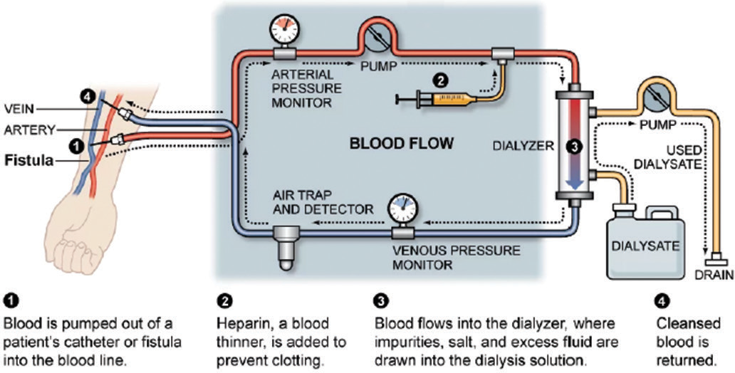 Dialysis Temperature Monitoring Hemodialysis