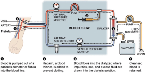 dialysis-diagram